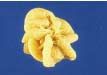 Oxalatsteine